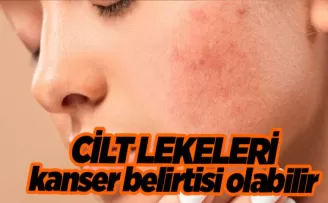 Cildinizde leke varsa doktora koşun: Kanser belirtisi olabilir