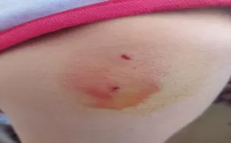 Kastamonu’da sahipsiz köpeklerin saldırdığı çocuğu babası kurtardı