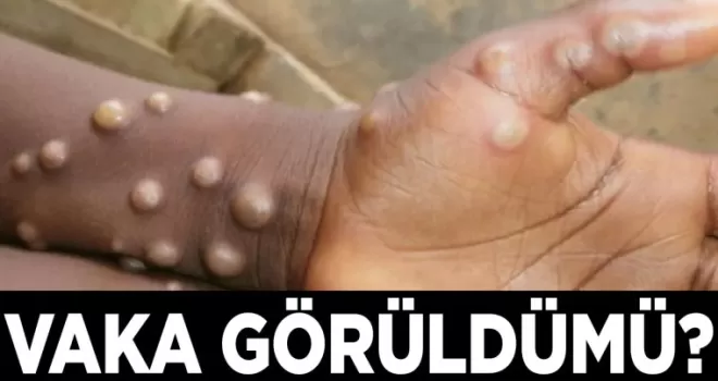 “Kongo’da Maymun Çiçeği Kabusu Büyüyor! 35 Kişi Daha Hayatını Kaybetti!“