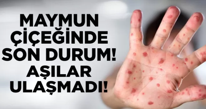 Maymun çiçeğinde son durum! Aşılar ulaşmadı