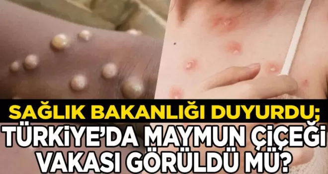 Sağlık Bakanlığı Duyurdu: Türkiye’de Maymun Çiçeği Vakası...