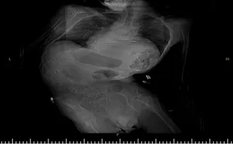 Samsun'da bir hastanın omurga eğriliği 5,5 saatlik ameliyatla düzeltildi